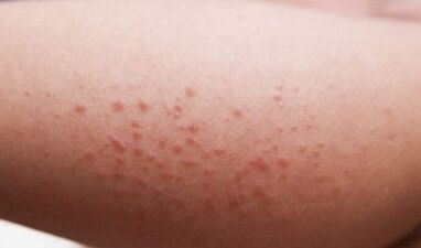 vanjske manifestacije prisutnosti parazita u tijelu